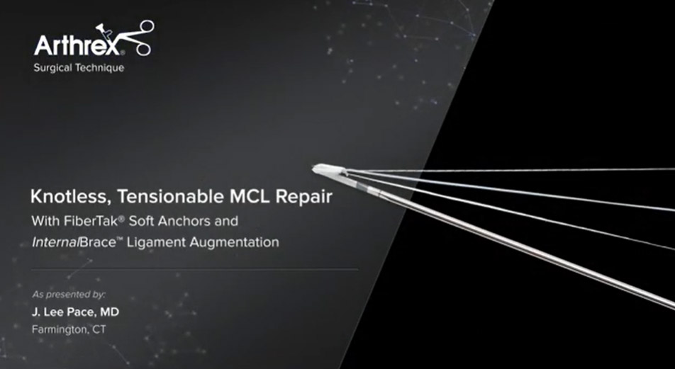 Knotless, Tensionable MCL Repair