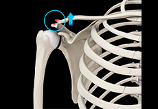 AC Joint Dislocation