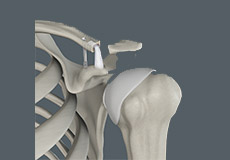 Acromioclavicular (AC) Joint Reconstruction