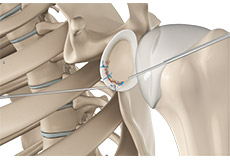 Bony Instability Reconstruction of the Shoulder