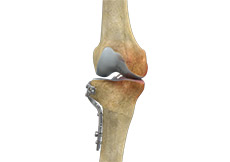 High Tibial Osteotomy