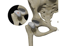 Hip Cartilage Restoration
