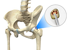 Hip Microfracture