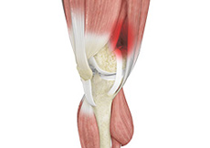 Iliotibial Band Syndrome