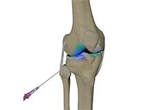 Intra-Articular Joint Injections