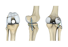 Ligament Preservation