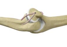 Ligament Reconstruction