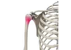 Little League Shoulder