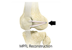 Medial Patellofemoral Ligament (MPFL) Reconstruction