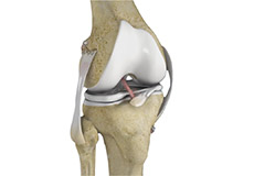 Multiligament Reconstruction of the Knee