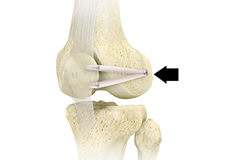 Patella Stabilization