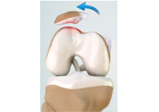 Patellar Dislocation/Patellofemoral Dislocation