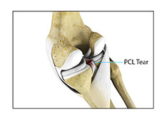 PCL Injuries