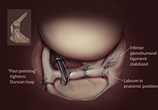 Shoulder Labral Repair