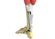 Ligament Reconstruction