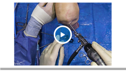 Arthroscopic Lateral Meniscus Transplantation